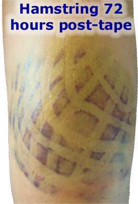 Kinesio Taping Our Services Healing Touch Natural Wellness